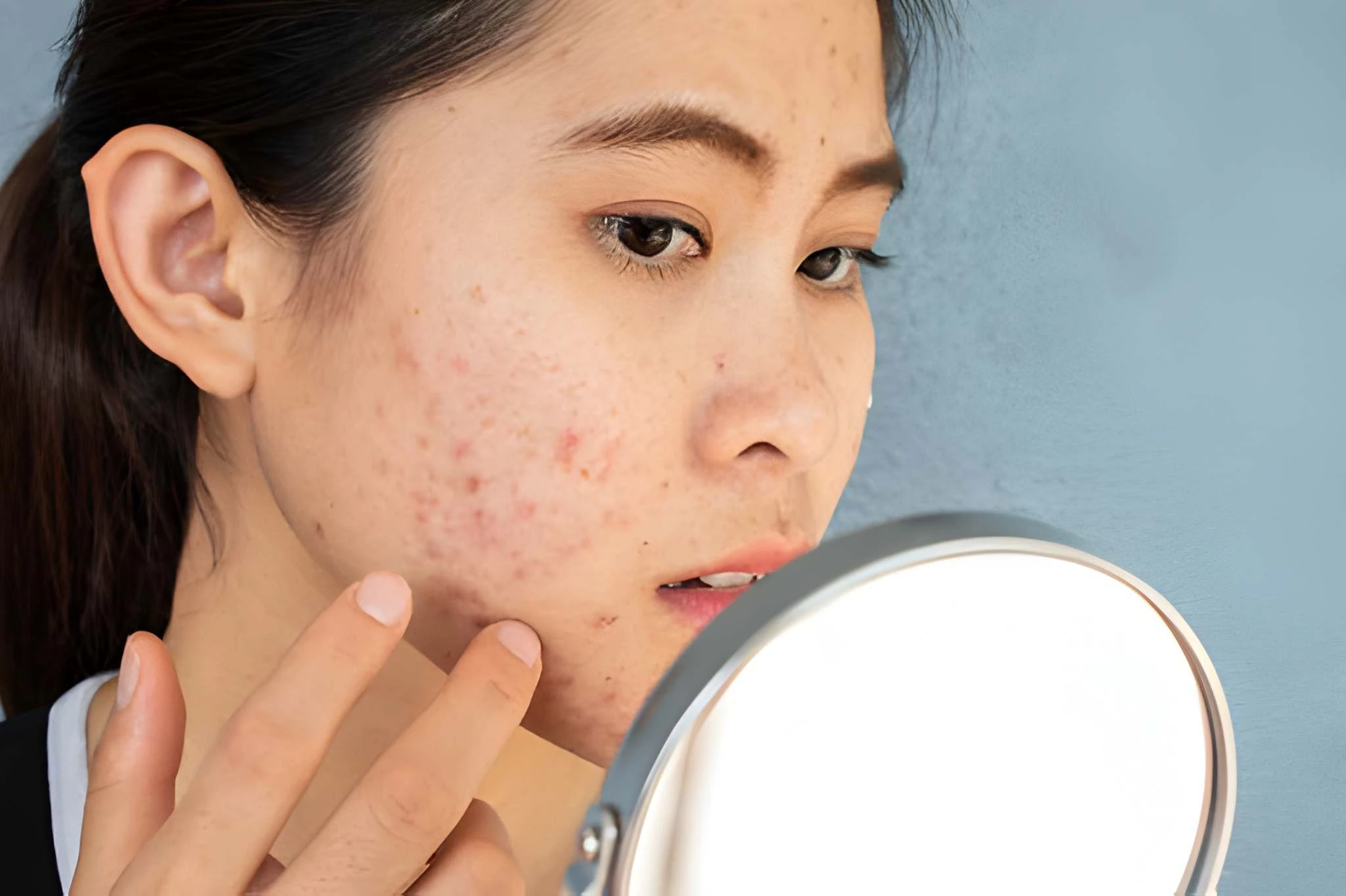 Beruntusan: Penyebab, Cara Mengatasinya, dan Tips Untuk Mencegahnya