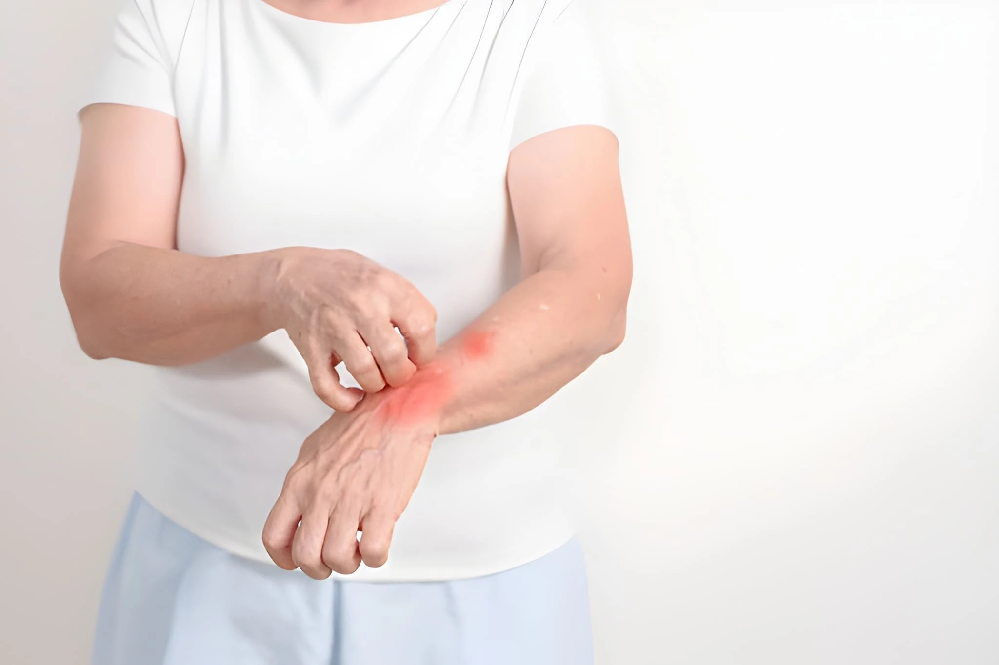 Kusta: Penyebab, Gejala, dan Cara Mengobatinya