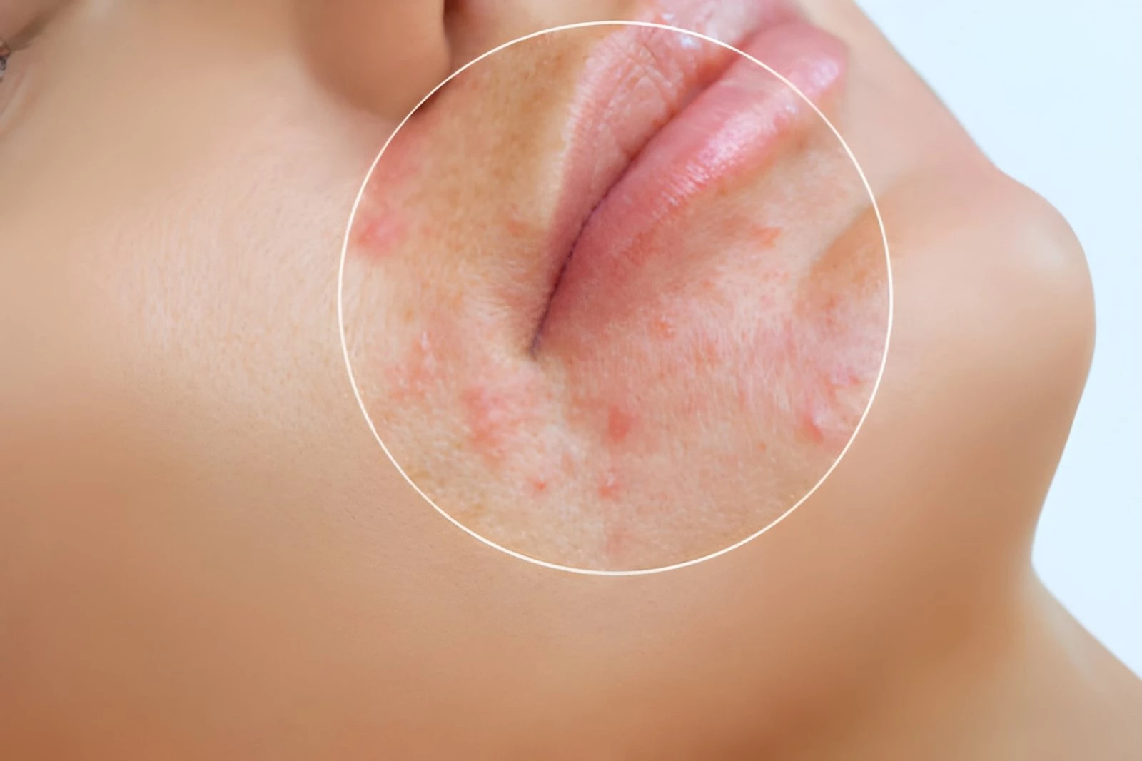 Penyebab Tumbuhnya Jerawat di Bibir dan Cara Mengatasinya Dengan Tepat