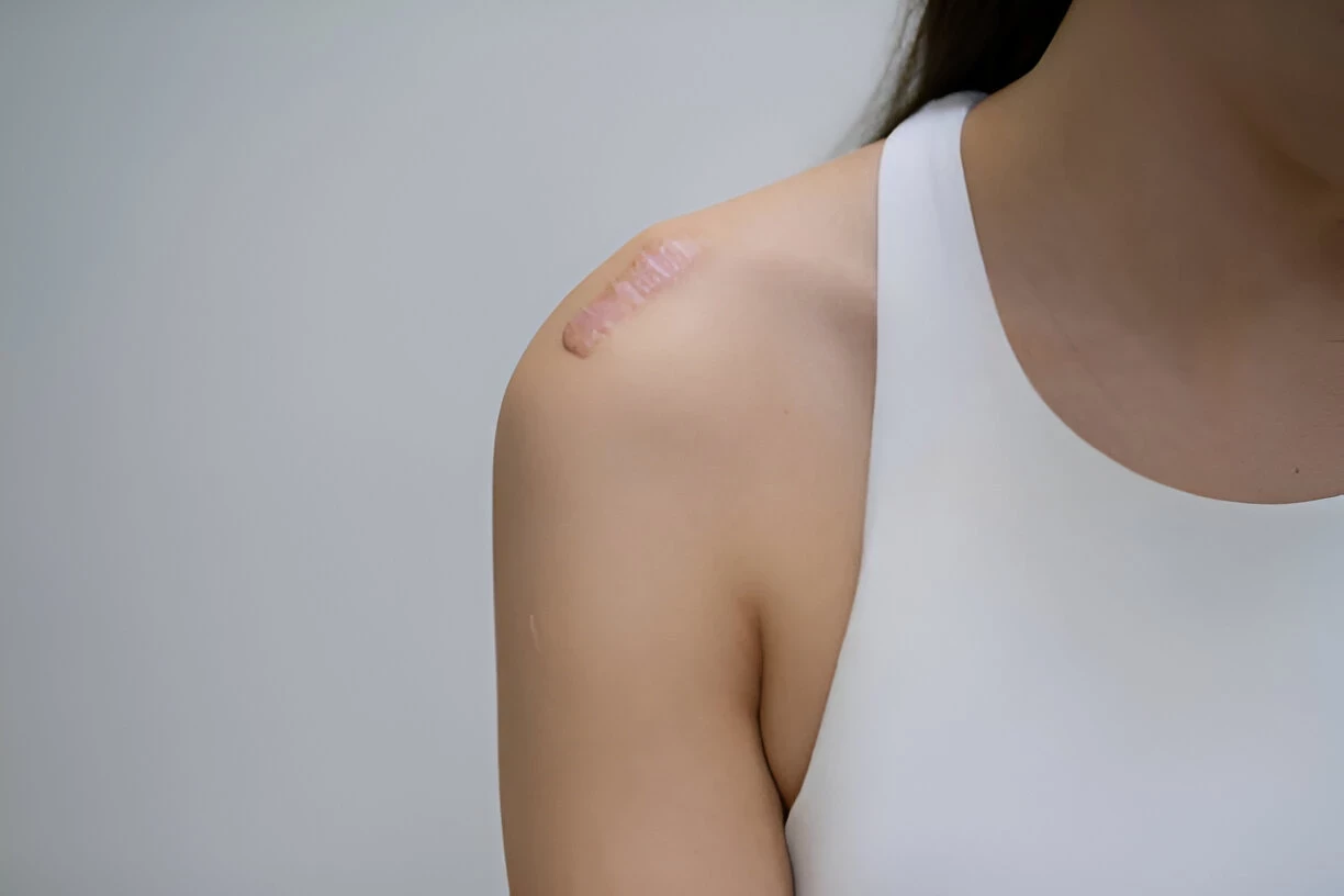 Keloid: Penyebab, Gejala, dan Cara Mengatasinya