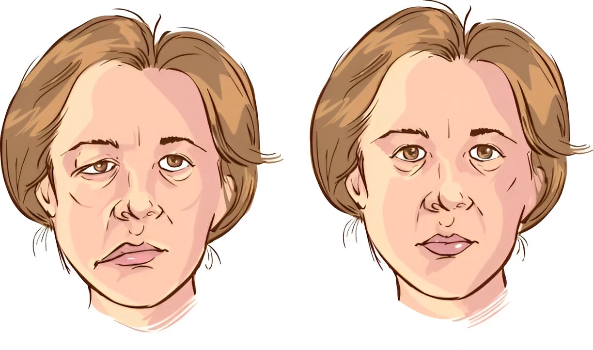Bell's Palsy: Penyebab, Gejala dan Cara Mengatasinya
