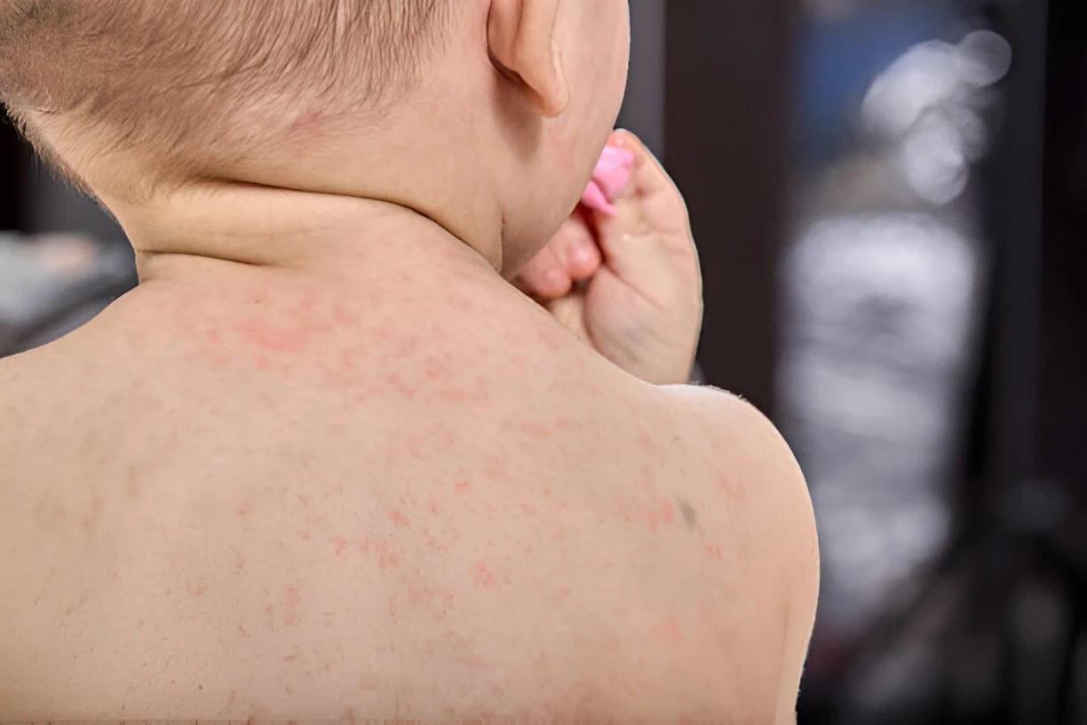 Roseola: Penyakit Kulit Yang Umum Menyerang Bayi dan Balita