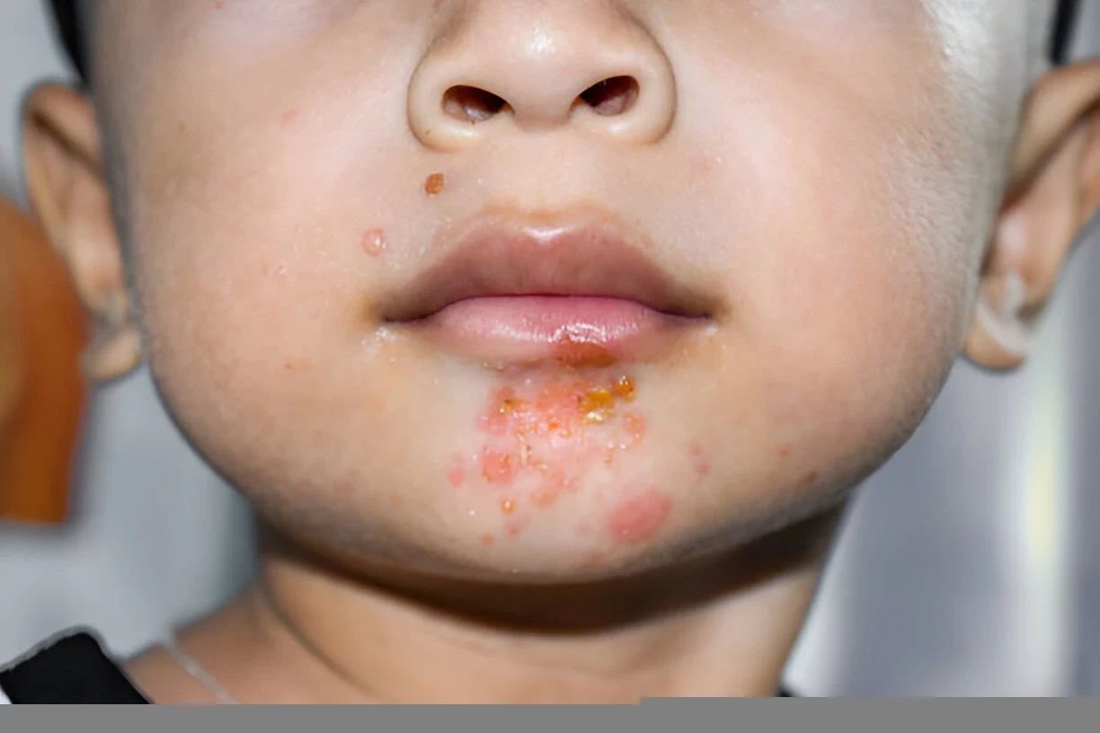 Impetigo: Penyebab, Gejala dan Cara Mengobatinya