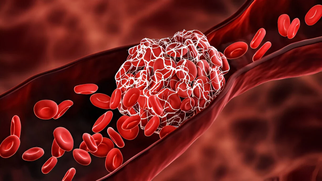 Deep Vein Thrombosis (DVT): Penyebab, Gejala, dan Cara Mengatasinya