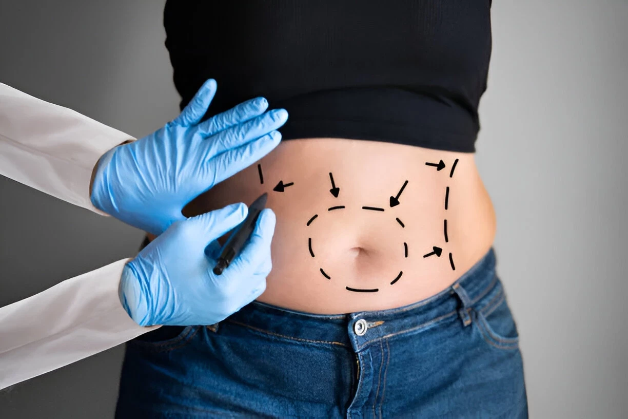 Tummy Tuck: Ketahui Manfaat dan Resikonya bagi Kesehatan