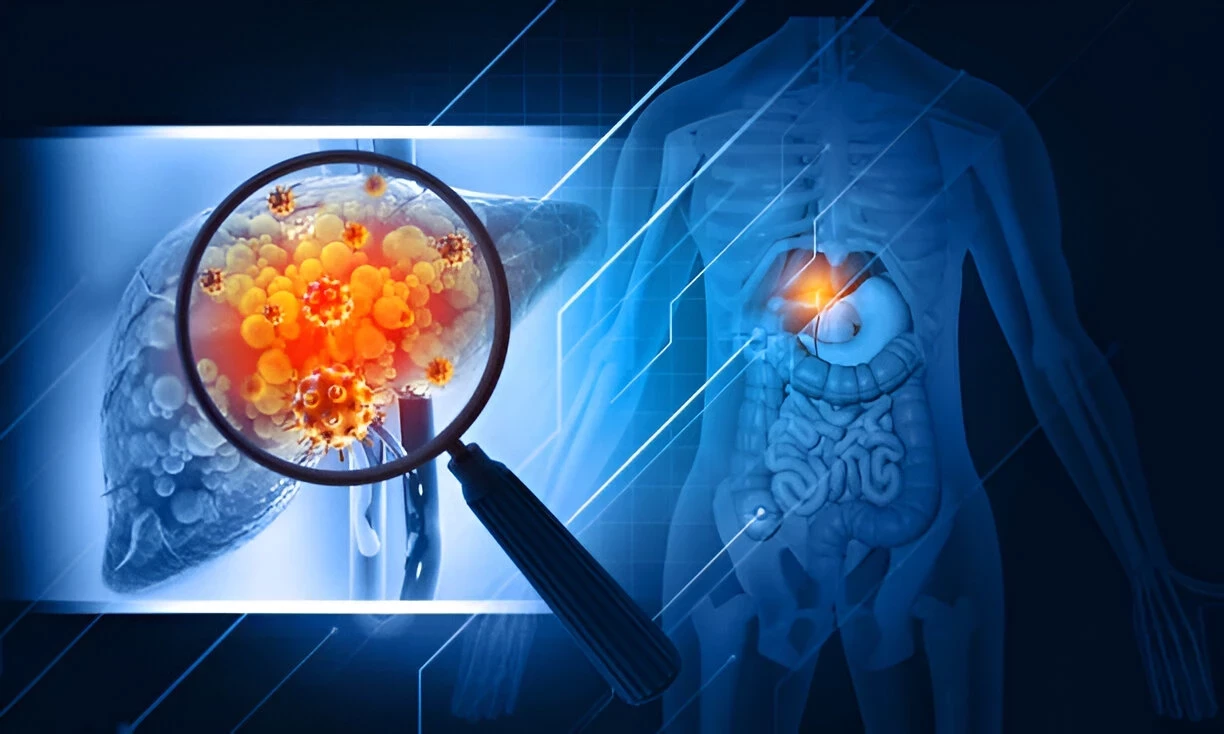 6 Makanan Yang Dapat Memicu Fatty Liver (Perlemakan Hati)