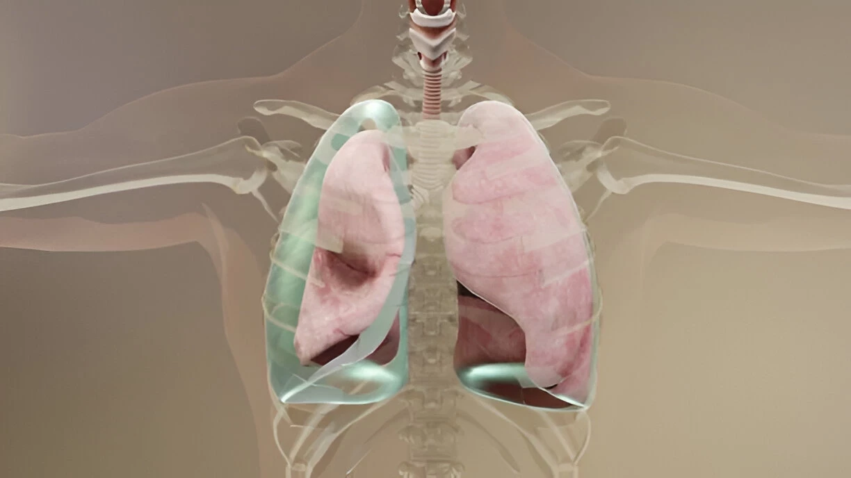 Pneumothorax: Penyebab, Gejala, dan Cara Mengatasinya