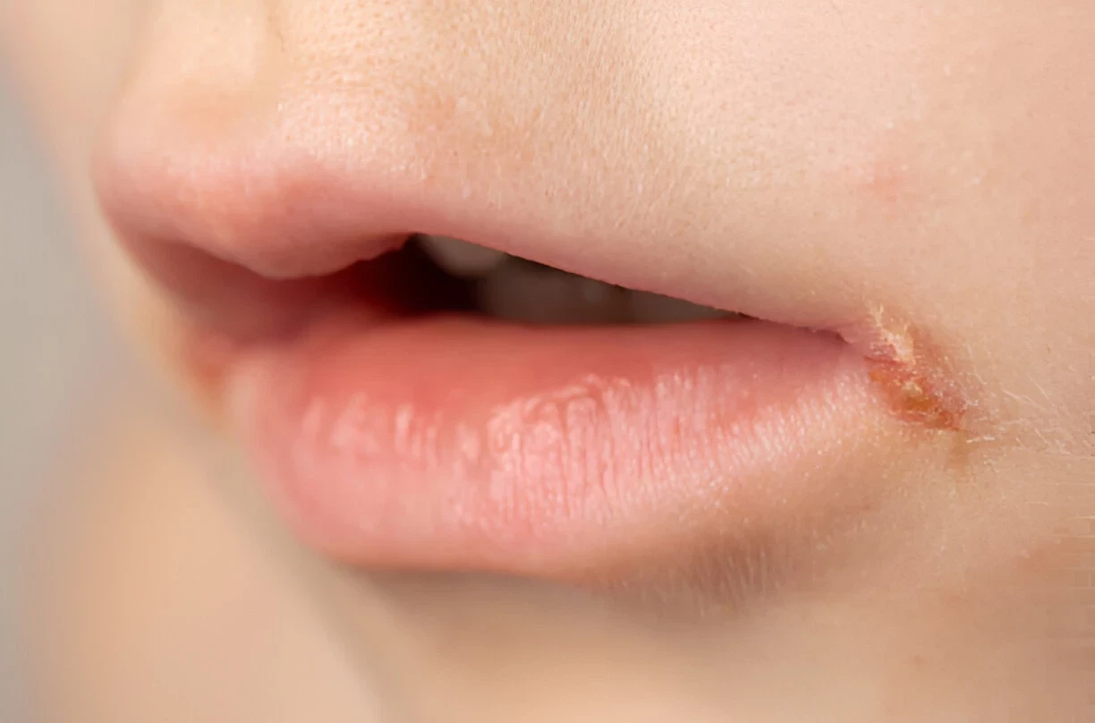 Angular Cheilitis (Luka di Sudut Bibir): Penyebab, Gejala, dan Cara Mengatasinya