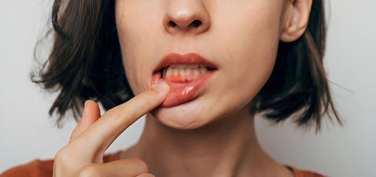 Periodontitis: Penyebab, Gejala, dan Cara Mengatasinya