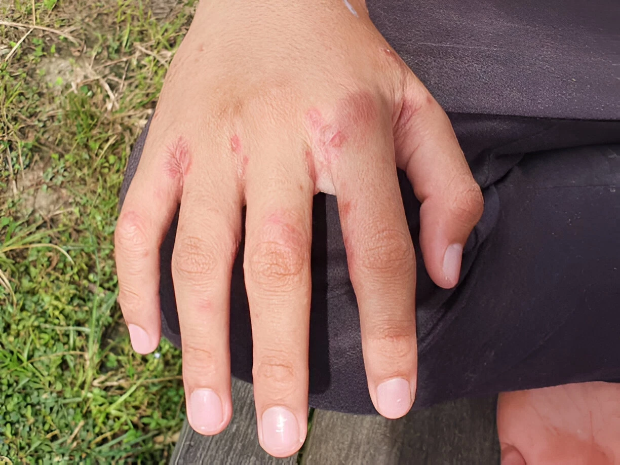 Scabies (Kudis): Gejala, Penyebab, Serta Cara Mengobati dan Mencegahnya
