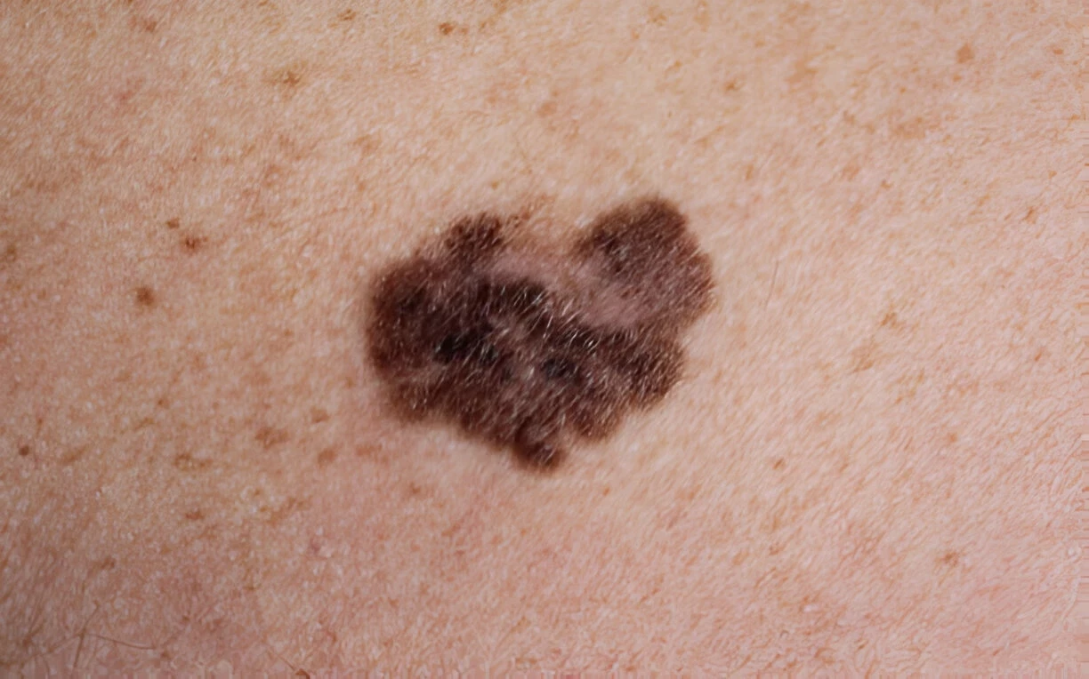 Melanoma: Penyebab, Gejala, Serta Cara Mencegah dan Mengobatinya