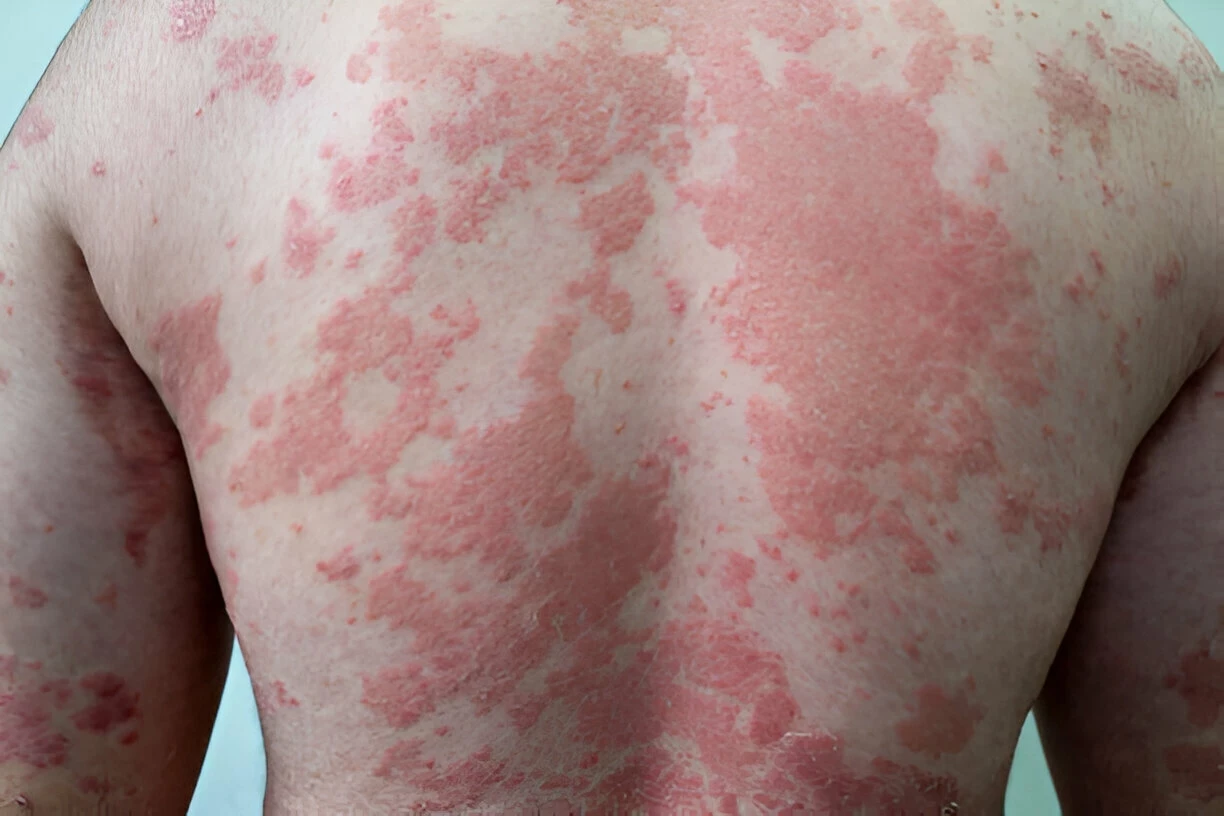 Psoriasis Vulgaris: Penyebab, Gejala dan Cara Mengobatinya