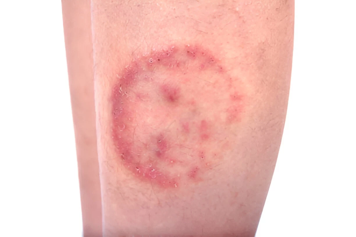 Tinea Corporis: Mengenal Lebih Dalam Mengenai Infeksi Jamur Pada Kulit dan Kepala