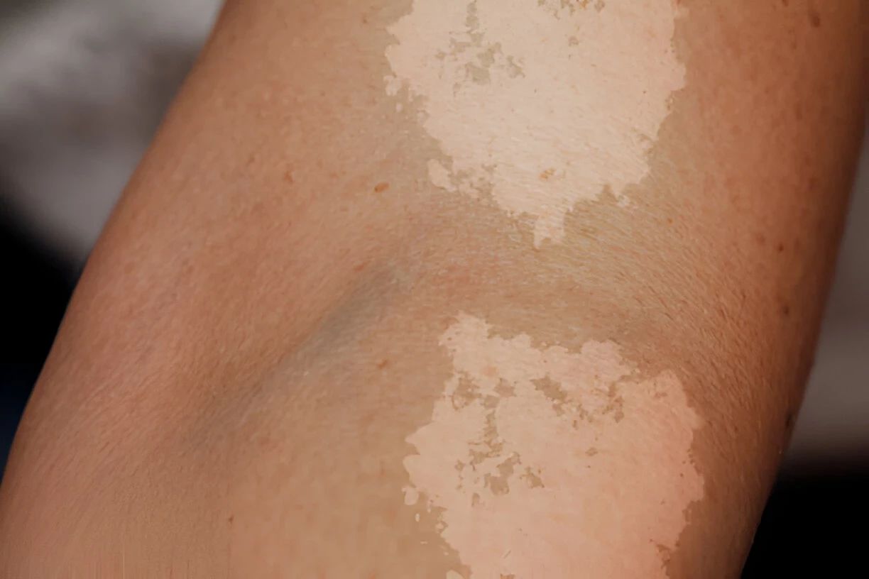 Panu (Tinea Versicolor): Penyebab, Gejala, dan Cara Mengobatinya