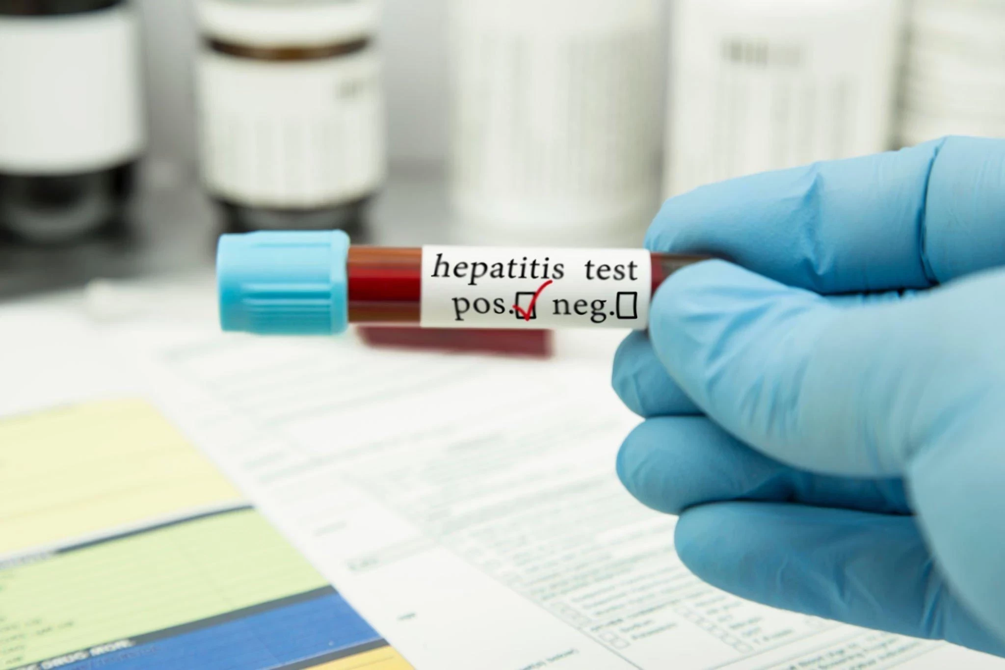 Hepatitis: Jenis, Gejala, Pengobatan, dan Cara Mencegahnya
