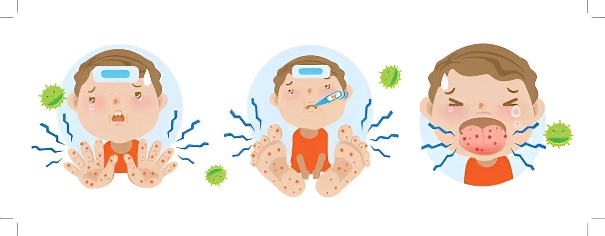 Penyakit Tangan, Kaki, dan Mulut (Virus HFMD): Penyebab, Gejala dan Cara Mencegahnya