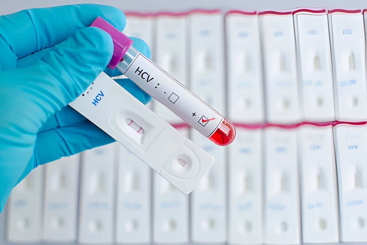 Hepatitis C: Penyebab, Gejala, Pengobatan Yang Tersedia, dan Langkah Pencegahan Yang Dapat Diambil