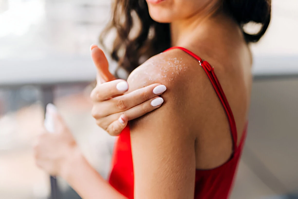 10 Cara Mengatasi Sunburn dan Mempercepat Pemulihan Kulit