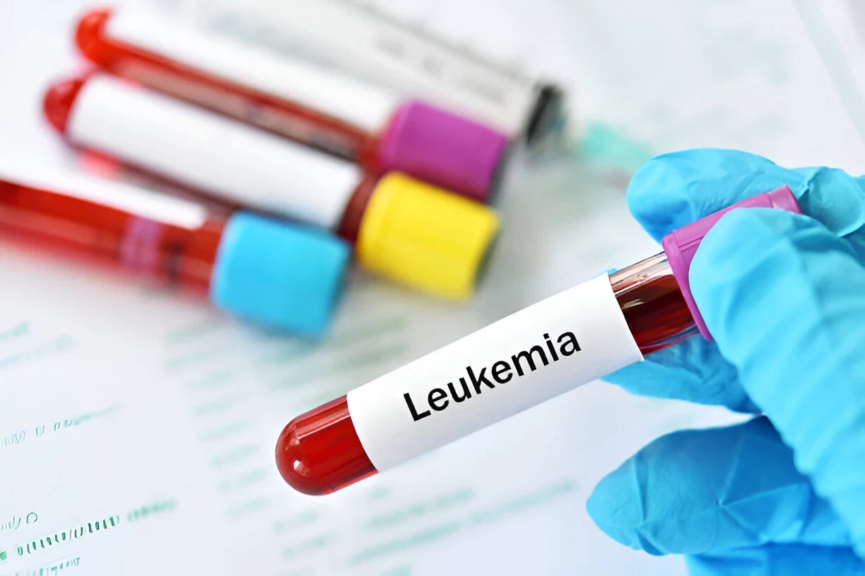 Leukemia: Gejala, Penyebab, dan Cara Mencegahnya