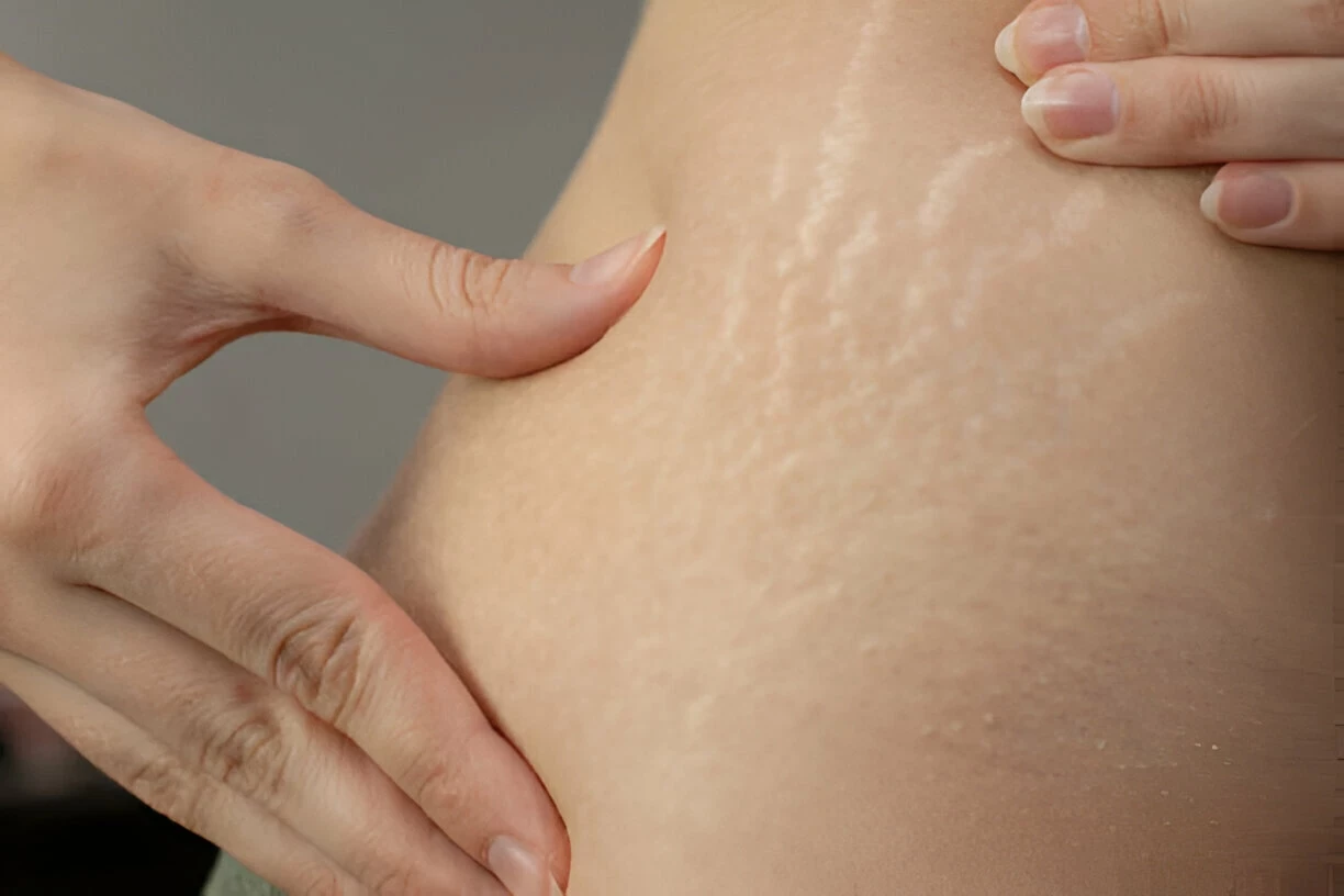 Stretch Mark: Penyebab dan Cara Mencegahnya