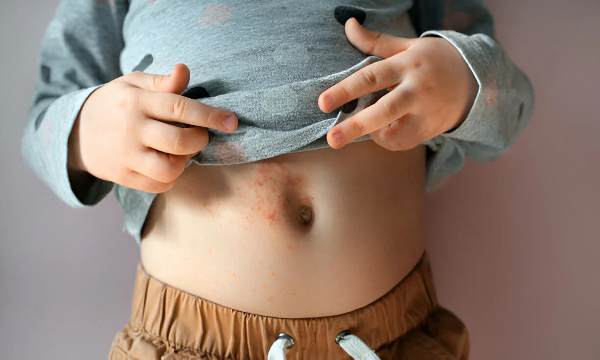 Scabies Pada Bayi: Penyebab, Gejala, dan Cara Mengobatinya