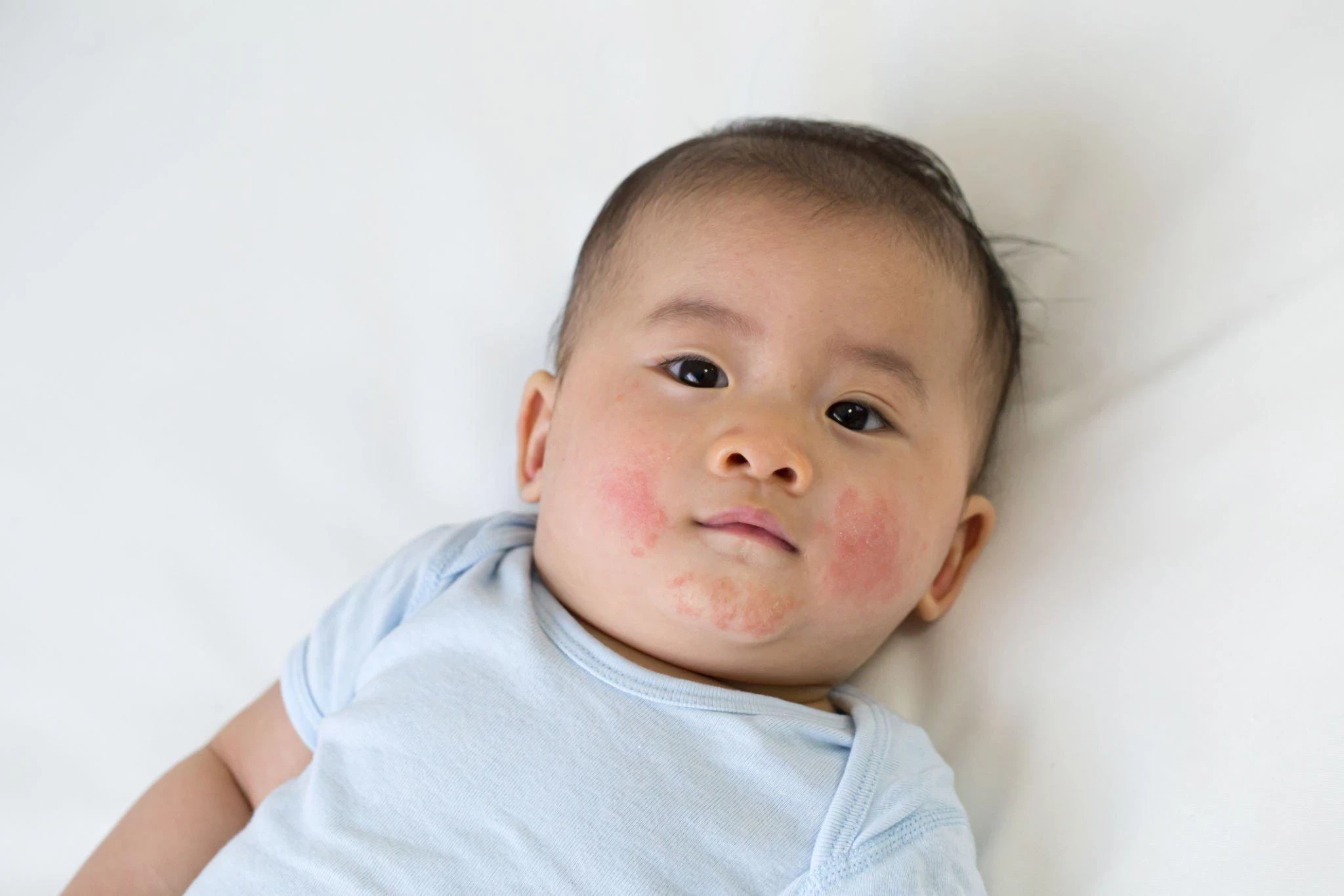 Penyakit Kelima (Erythema Infektiosum): Penyebab, Gejala, dan Cara Mengobatinya