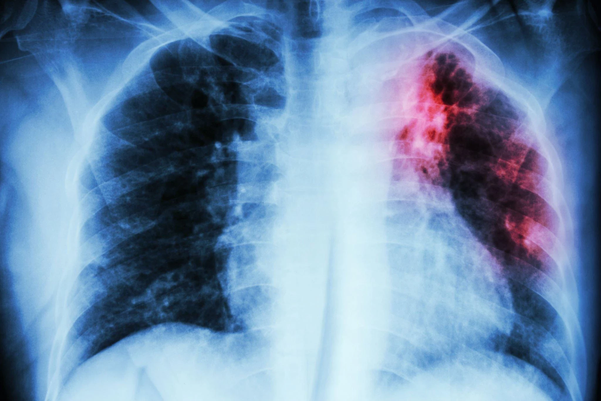 Tuberkulosis (TBC): Penyebab, Gejala, dan Cara Mengatasinya