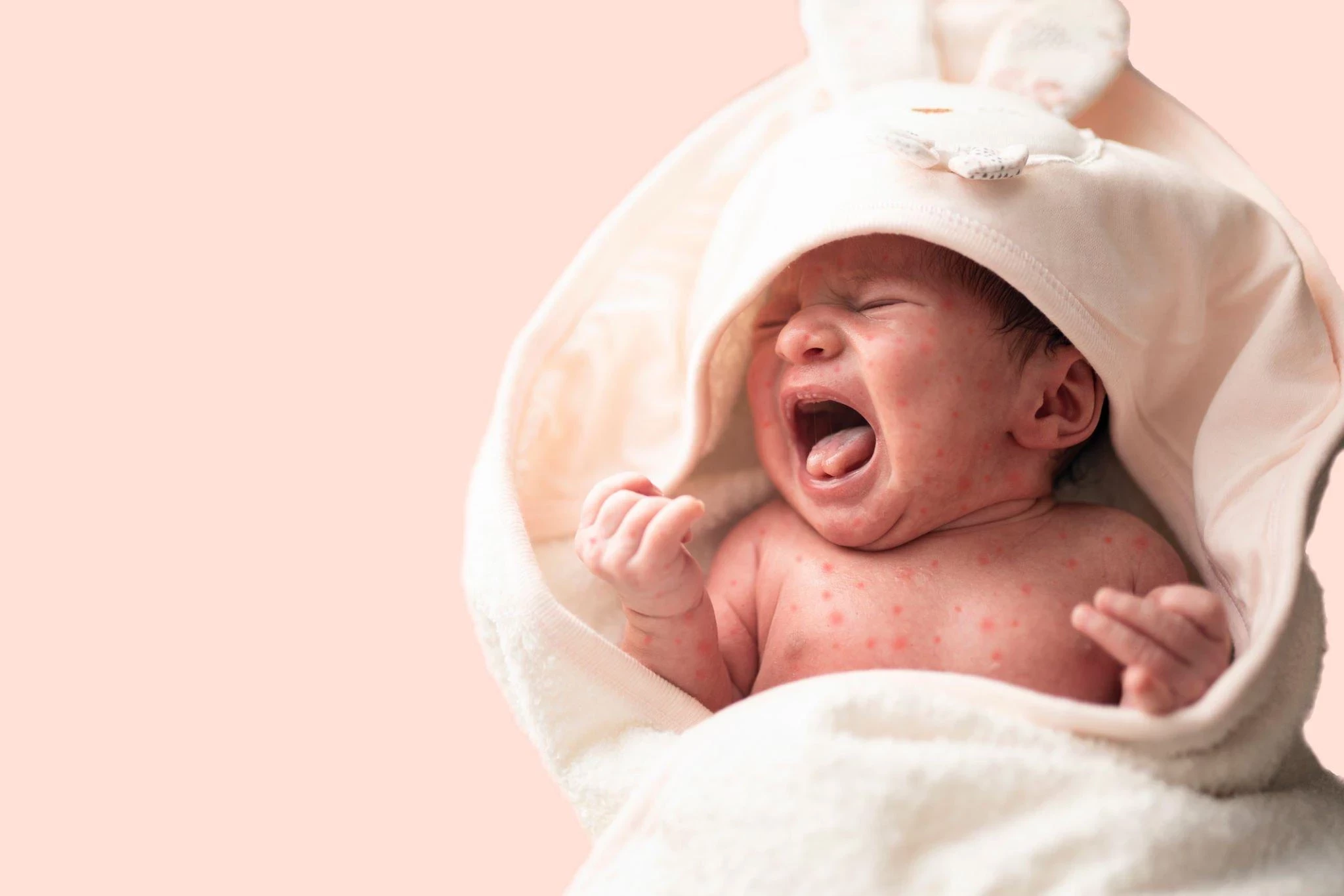 Campak Pada Bayi: Penyebab, Gejala, dan Cara Mencegahnya
