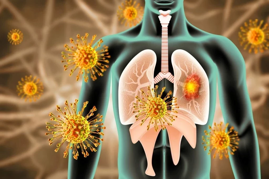 Virus Respiratory Syncytial (RSV): Gejala, Penyebab, Pengobatan, dan Cara Mencegahnya